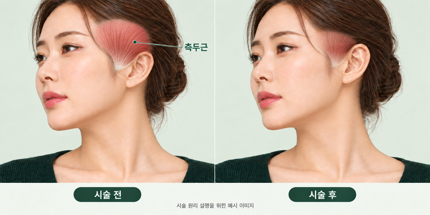 06. 측두근_전후.png